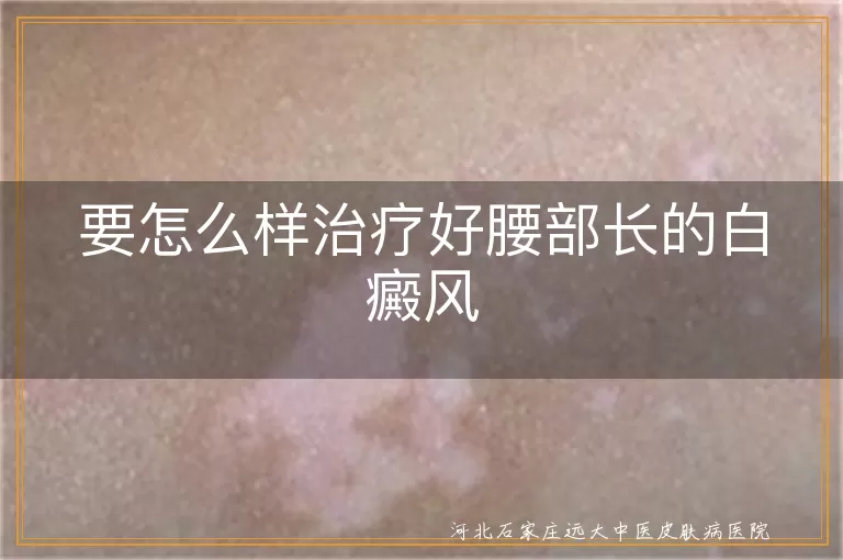 腰部白癜风根除攻略,白斑腰部怎么治,腰部长白斑怎样治疗