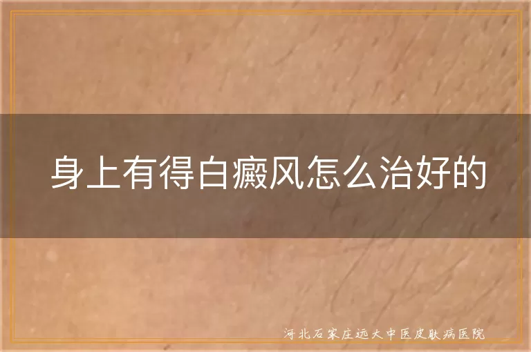 白癜风治愈攻略分享,白斑复色新路径,白癜风患者康复心得