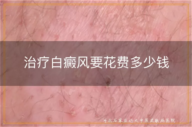 白癜风治疗费用精准估算,白斑治疗花费影响因素,白癜风花费如何预估