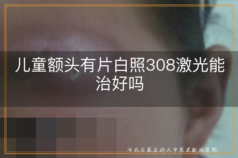 儿童白斑308激光疗法能治愈吗,额头白癜风照光效果评估,小儿白斑照308激光恢复概率