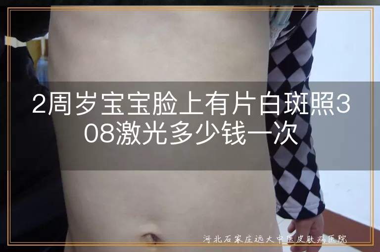 白斑宝宝照308激光价格,婴儿脸部白癜风费用,两岁幼童白斑治疗花费