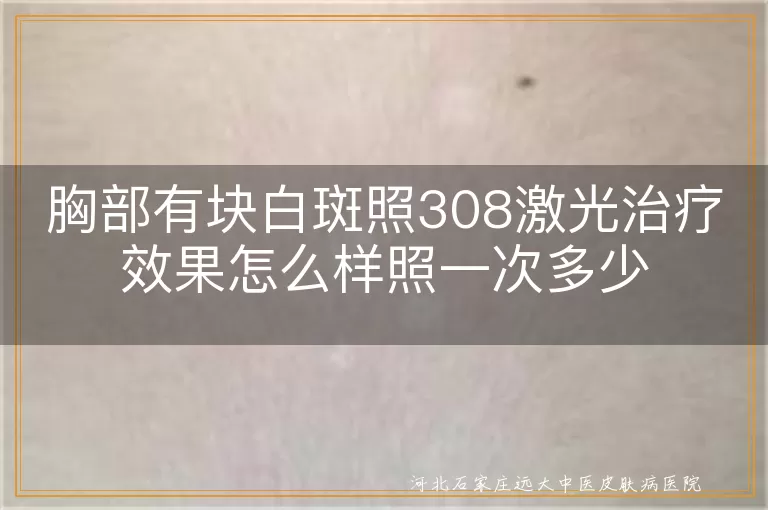 胸部白癜风308激光效果,白斑照308光一次多少钱,胸部白斑308纳米技术费用