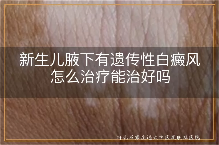新生儿腋下白斑治疗攻略,婴儿白癜风早期干预,遗传性白斑护理要点