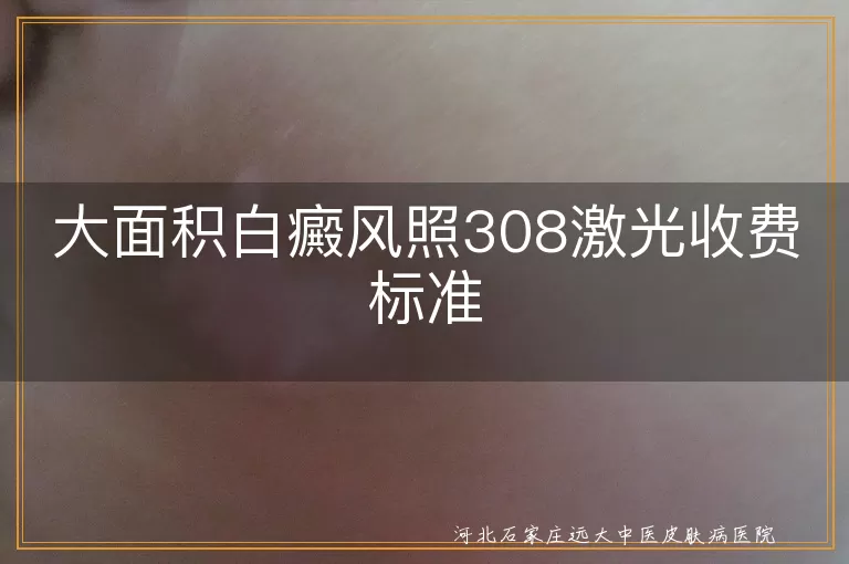 大面积白癜风照308激光收费标准