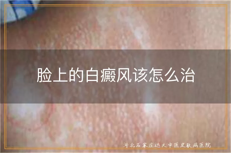 脸上的白癜风该怎么治