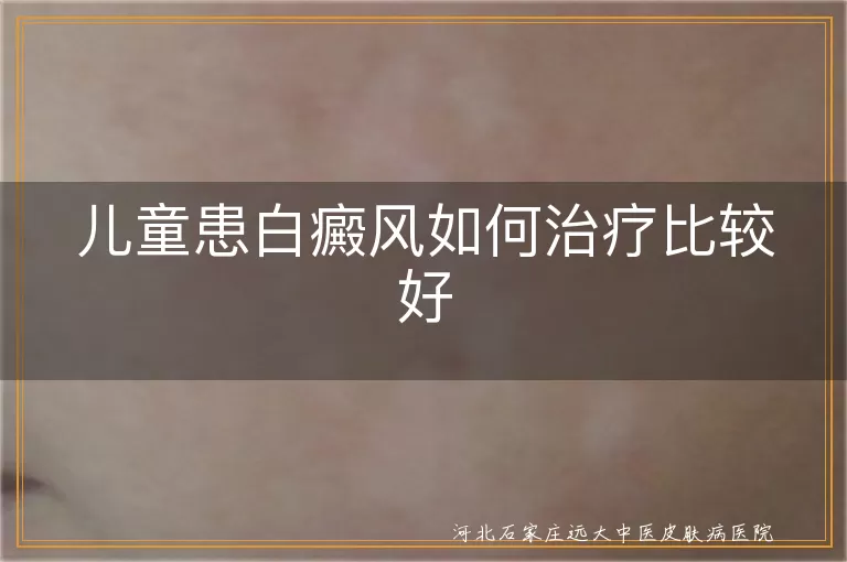 儿童患白癜风如何治疗比较好