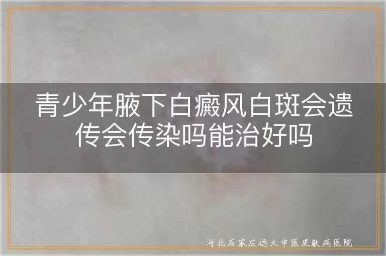 青少年腋下白癜风白斑会遗传会传染吗能治好吗