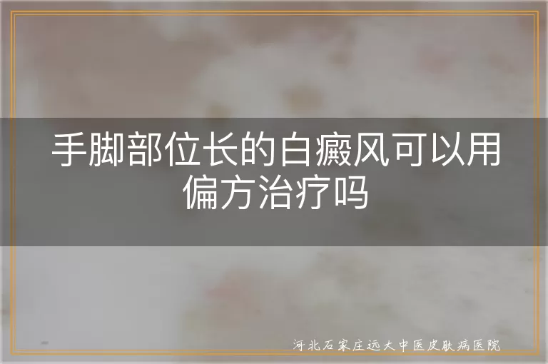 手脚部位长的白癜风可以用偏方治疗吗