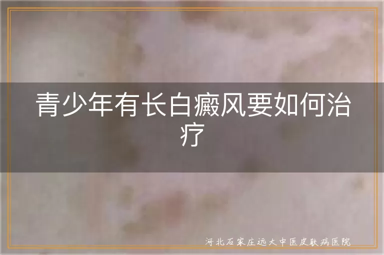青少年有长白癜风要如何治疗