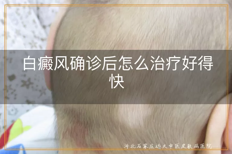 白癜风确诊后怎么治疗好得快