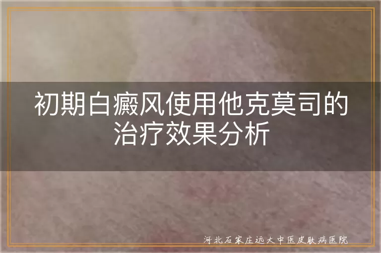 初期白癜风使用他克莫司的治疗效果分析