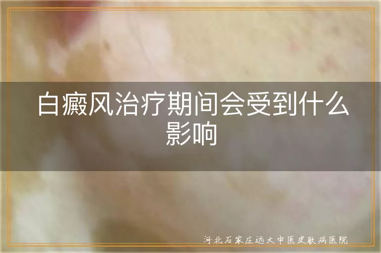治疗期间白斑会反复吗,白癜风用药影响体力吗,白斑疗程情绪波动大