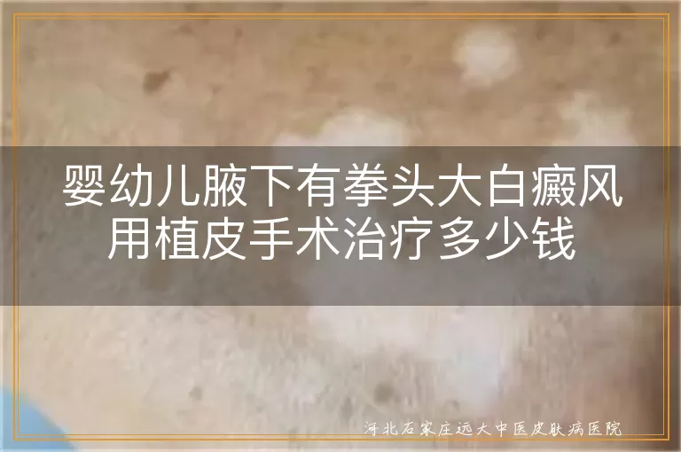 婴幼儿腋下有拳头大白癜风用植皮手术治疗多少钱