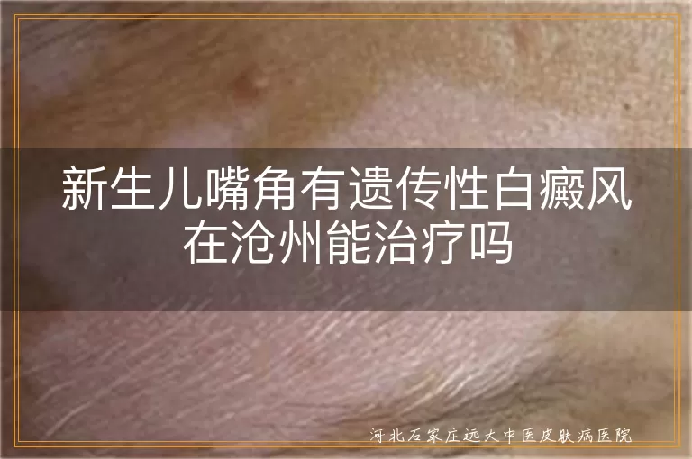 新生儿嘴角有遗传性白癜风在沧州能治疗吗