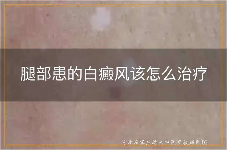 腿部患的白癜风该怎么治疗