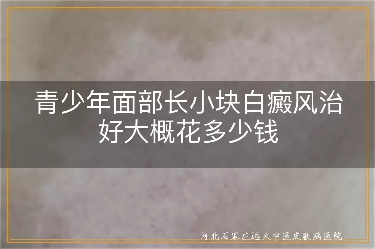 青少年面部白癜风治疗要花多少钱,轻微白斑治好预算解析,青少年小块白斑费用考量