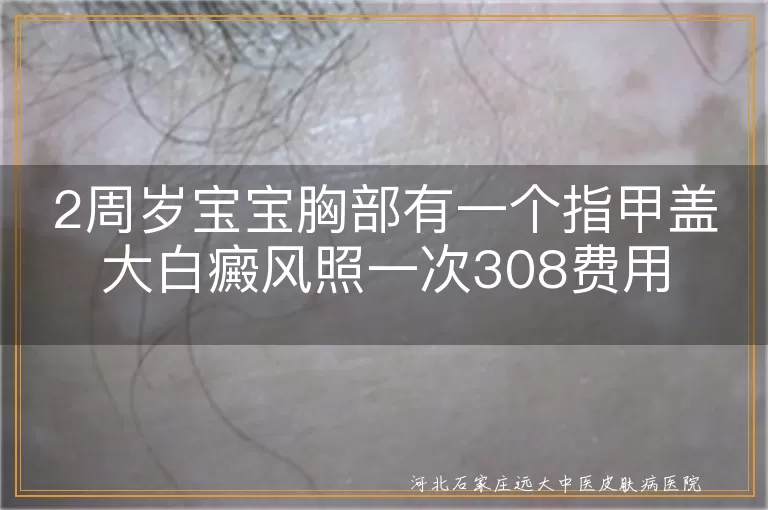 2岁宝宝胸部白斑治疗费用,婴儿白癜风308单次费用解析,婴幼儿白斑光疗价格参考