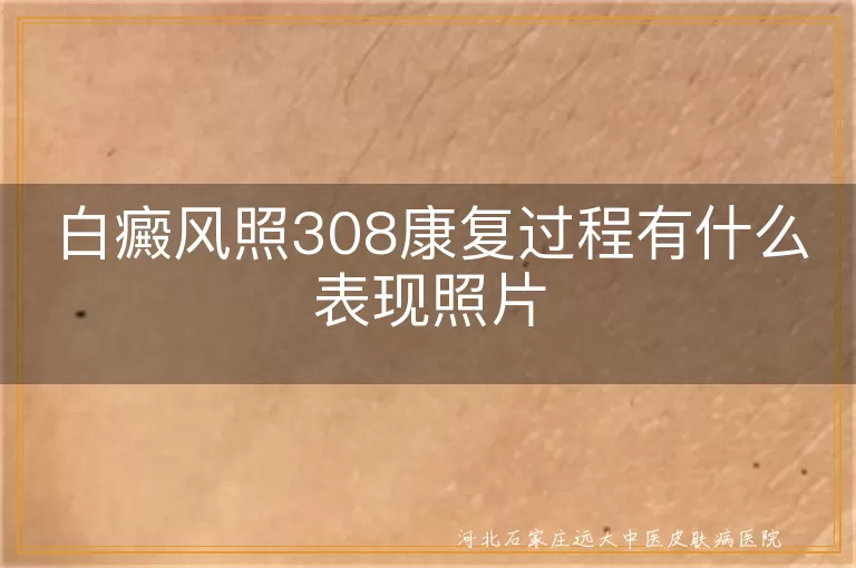 白癜风308照射实拍图,白斑激光修复效果照片,308激光治疗白斑变化过程