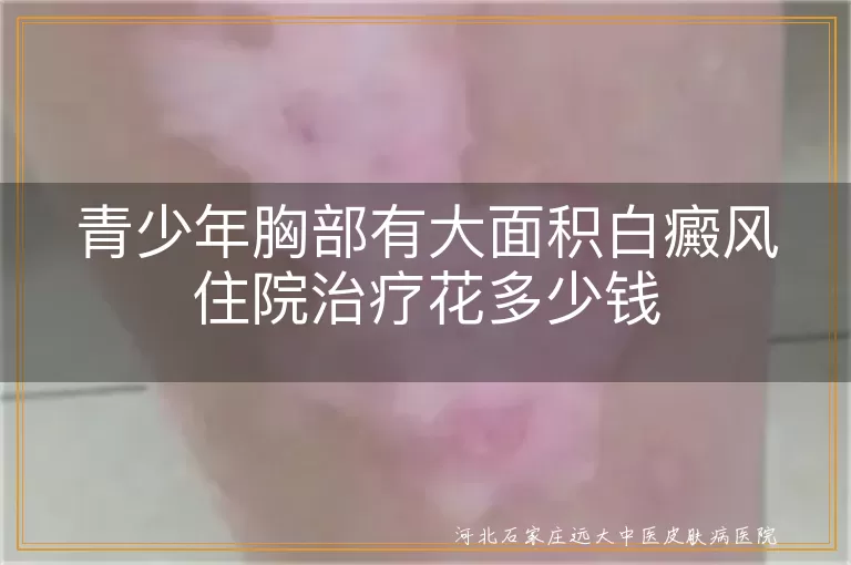 青少年胸部有大面积白癜风住院治疗花多少钱