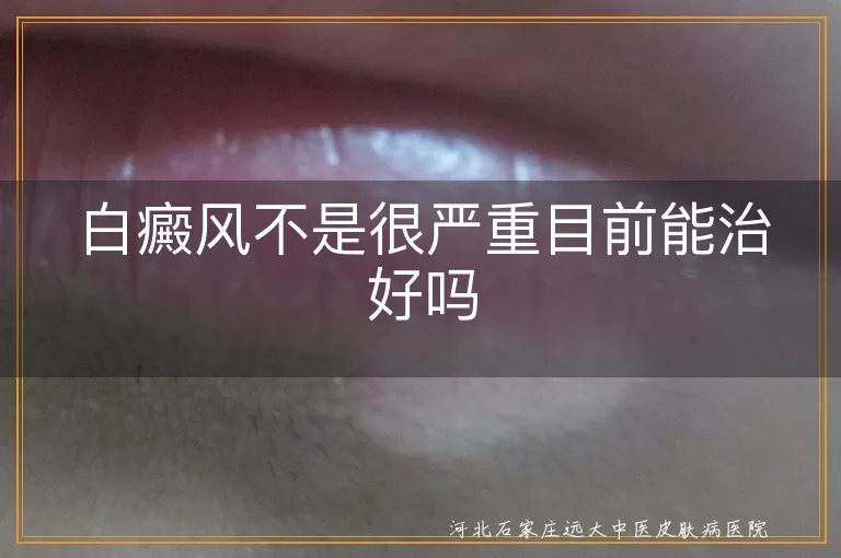 白癜风不是很严重目前能治好吗