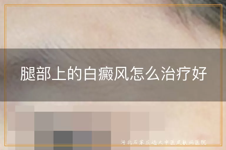 腿部白斑如何治,腿部白癜风治疗指南,下肢白癜风能好吗