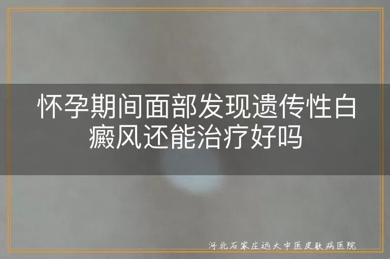 怀孕期间面部发现遗传性白癜风还能治疗好吗