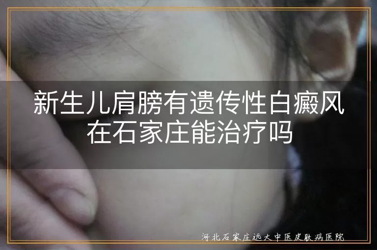 新生儿肩膀遗传性白斑案例,石家庄白癜风专科答疑,婴幼儿白斑针灸辅助方案