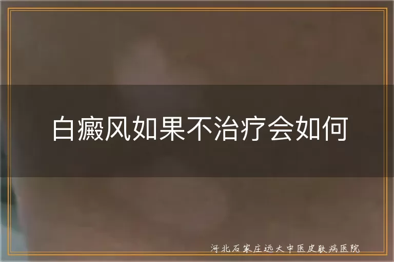 白癜风如果不治疗会如何