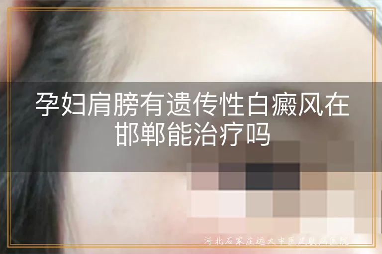 孕妇肩膀有遗传性白癜风在邯郸能治疗吗
