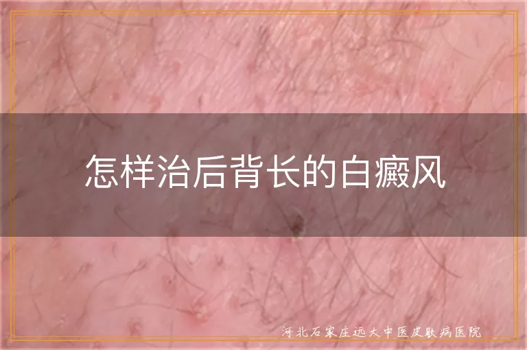 后背白斑治疗方法揭秘,后背白癜风日常管理要点,背部大面积白斑攻克攻略