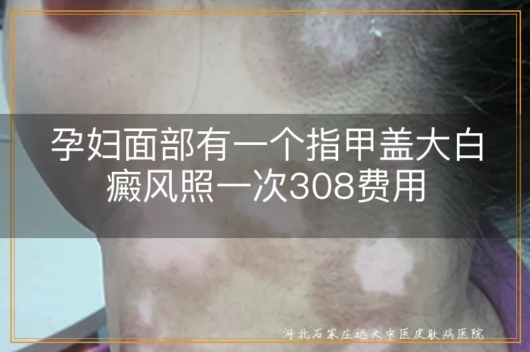 孕妇面部有一个指甲盖大白癜风照一次308费用