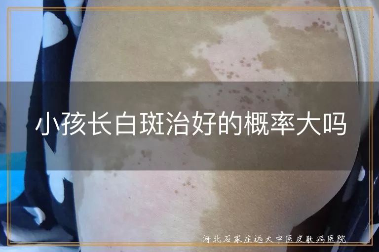小孩长白斑治好的概率大吗