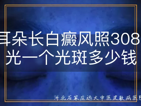 儿童耳朵白斑308费用,白癜风308光斑价格,308治疗白癜风花费