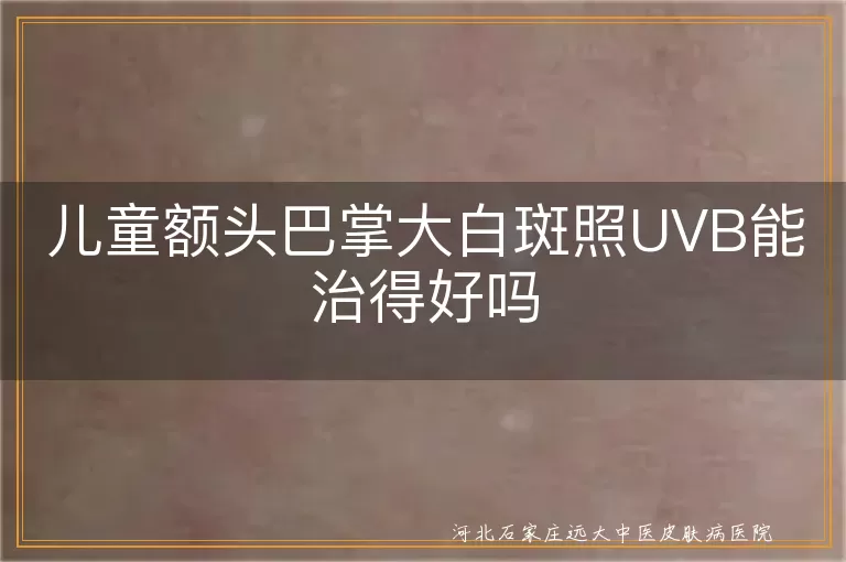 儿童额头白斑UVB治疗效果,额头白癜风光疗成功率高吗,宝宝白癜风照窄谱UVB能好吗