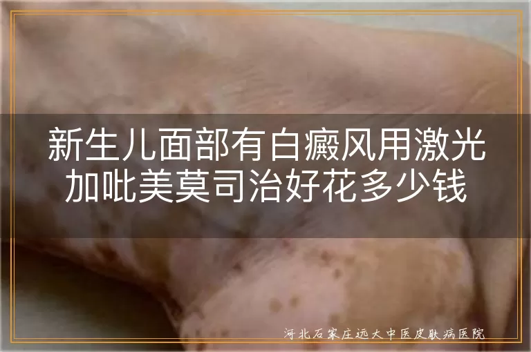 新生儿面部白斑激光吡美莫司费用,婴儿脸部白癜风治疗价格,小儿面部白癜风康复开销