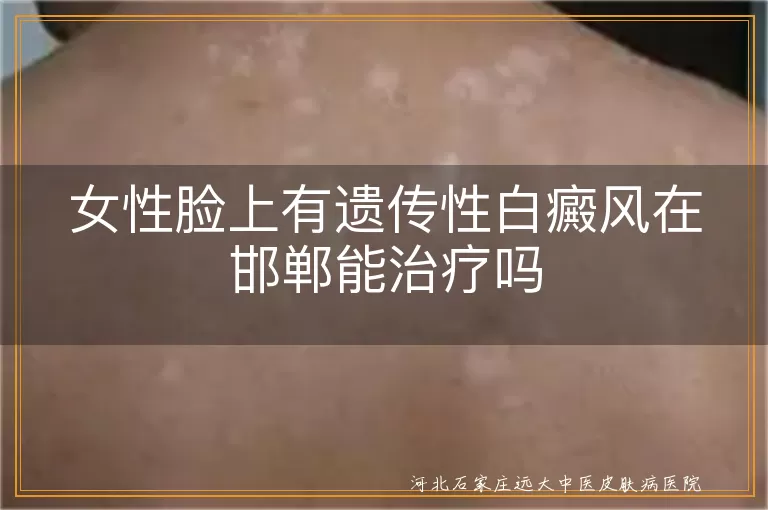 女性脸上有遗传性白癜风在邯郸能治疗吗