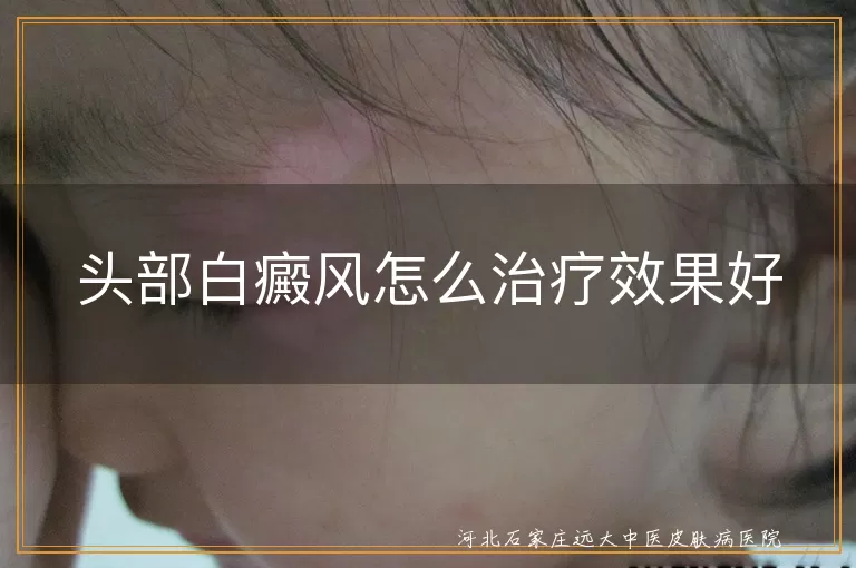 头部白癜风怎么治疗效果好