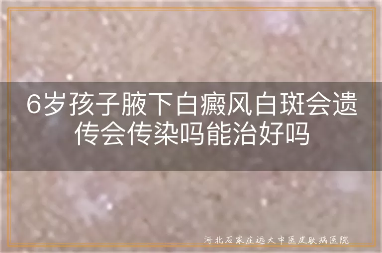 6岁孩子腋下白癜风白斑会遗传会传染吗能治好吗