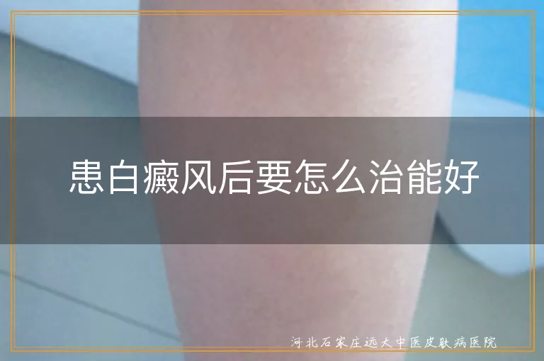 患白癜风后要怎么治能好