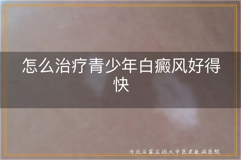 怎么治疗青少年白癜风好得快