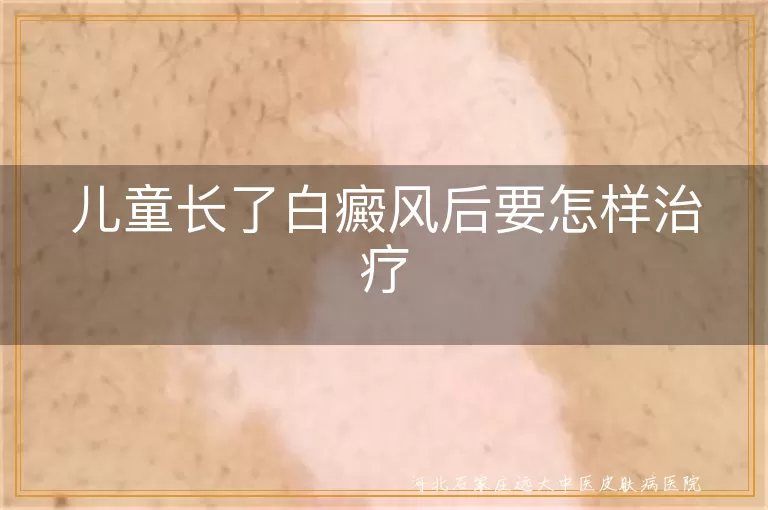 儿童长了白癜风后要怎样治疗