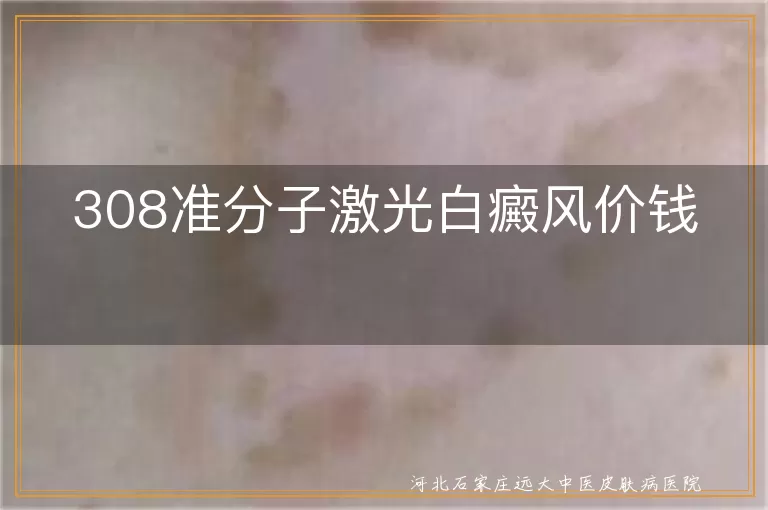 308准分子激光白癜风价钱