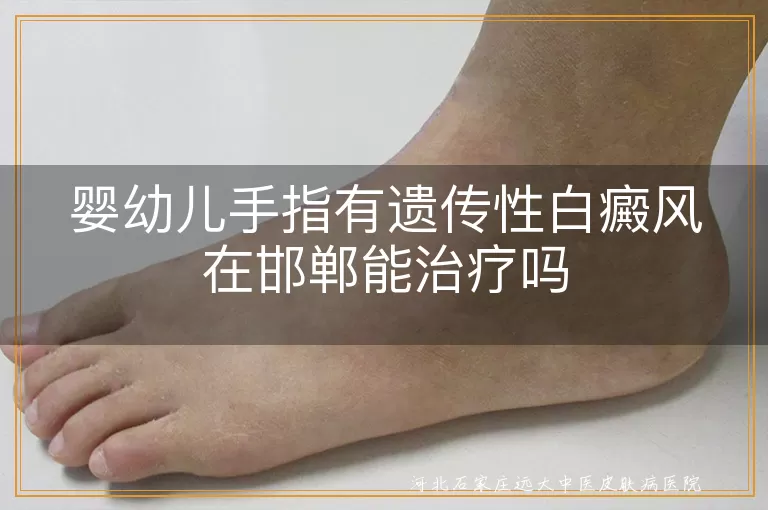 祖辈白斑遗传低幼手指能治,邯郸孩童白癜风恢复路线,遗传性白斑宝宝手指干预方案