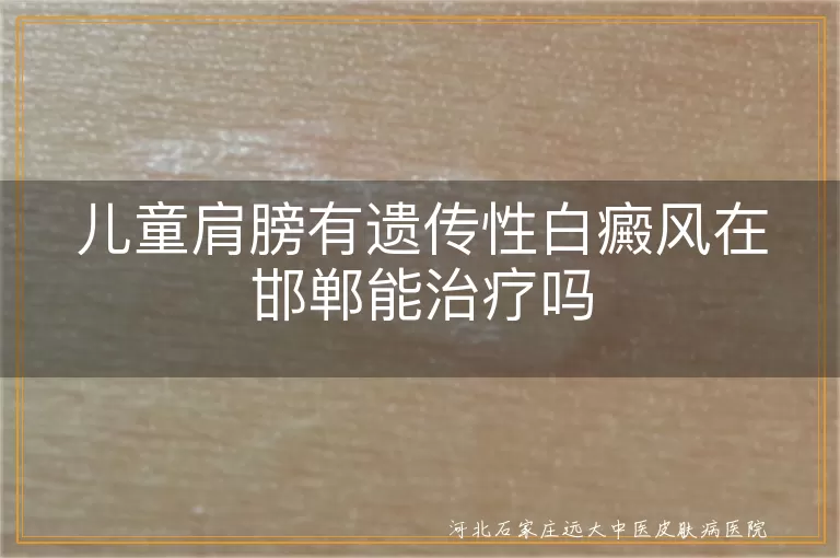 儿童肩膀遗传性白斑怎么办,邯郸儿童早期白癜风干预,白斑小患者家长最关心的问题