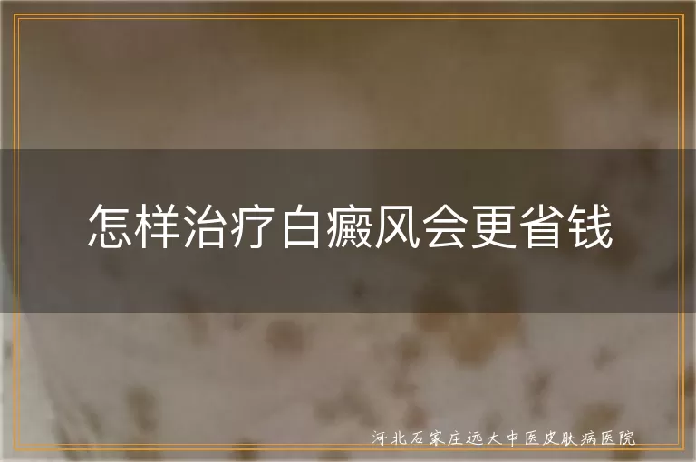 白癜风省钱治疗指南,白斑经济疗法方案,低费用治白癜风攻略