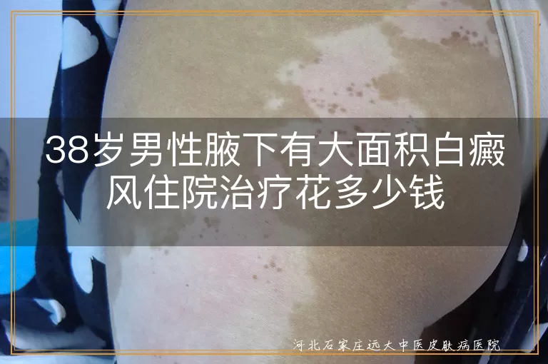 38岁男性腋下白癜风治疗费用,大面积白癜风住院到底花多少,腋下白癜风白斑花销参考