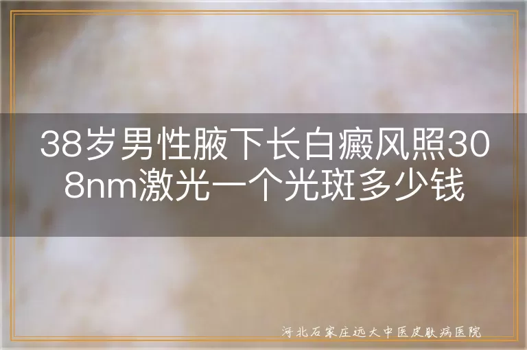 腋下白斑照308价格,白癜风308光斑收费,白癜风激光单价参考,白癜风腋下治疗费用