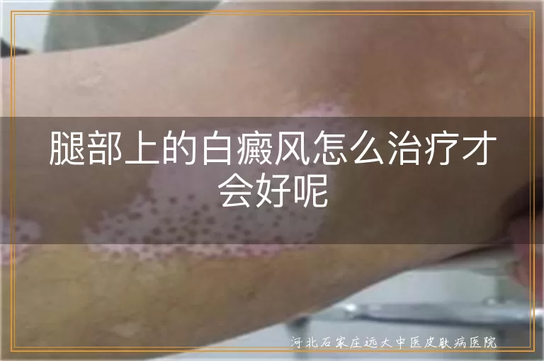 腿部上的白癜风怎么治疗才会好呢