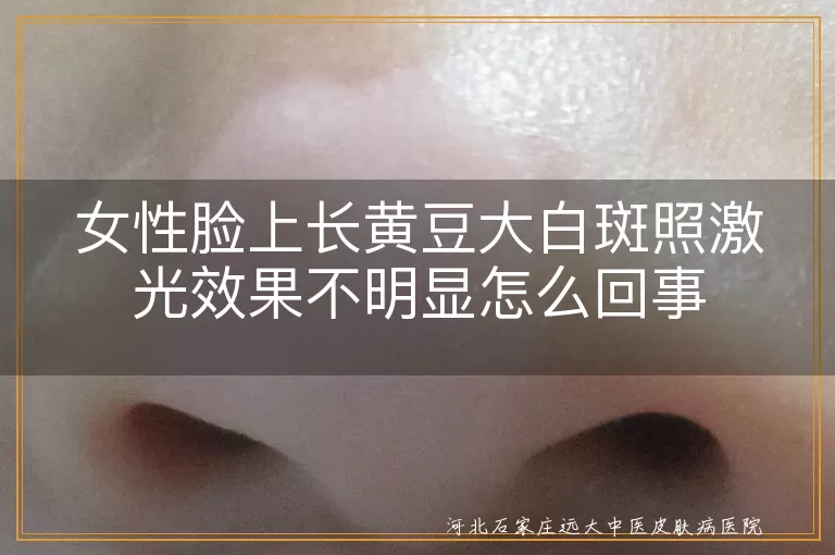 女性脸上长黄豆大白斑照激光效果不明显怎么回事
