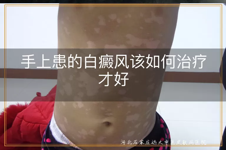 手上患的白癜风该如何治疗才好